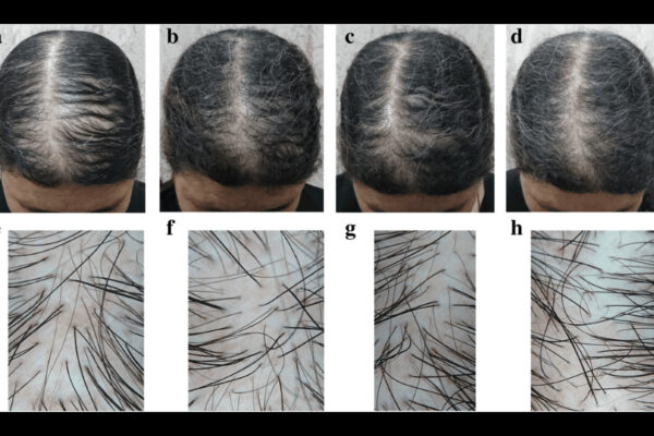Topical Dimethylglycine Sodium Salt and Caffeine Shampoo Promising for Treating Male Pattern Baldness: Study