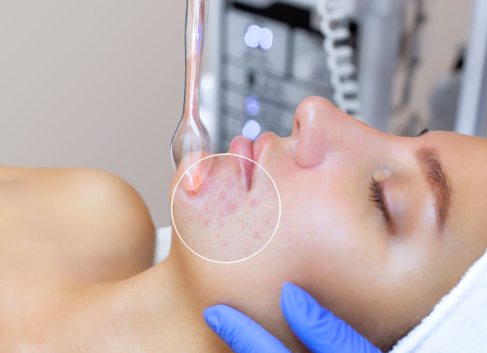 Acne Types, Causes and Treatment Options