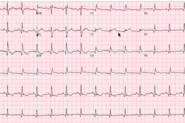 Annals ECG of the Month: Acute Coronary Occlusion