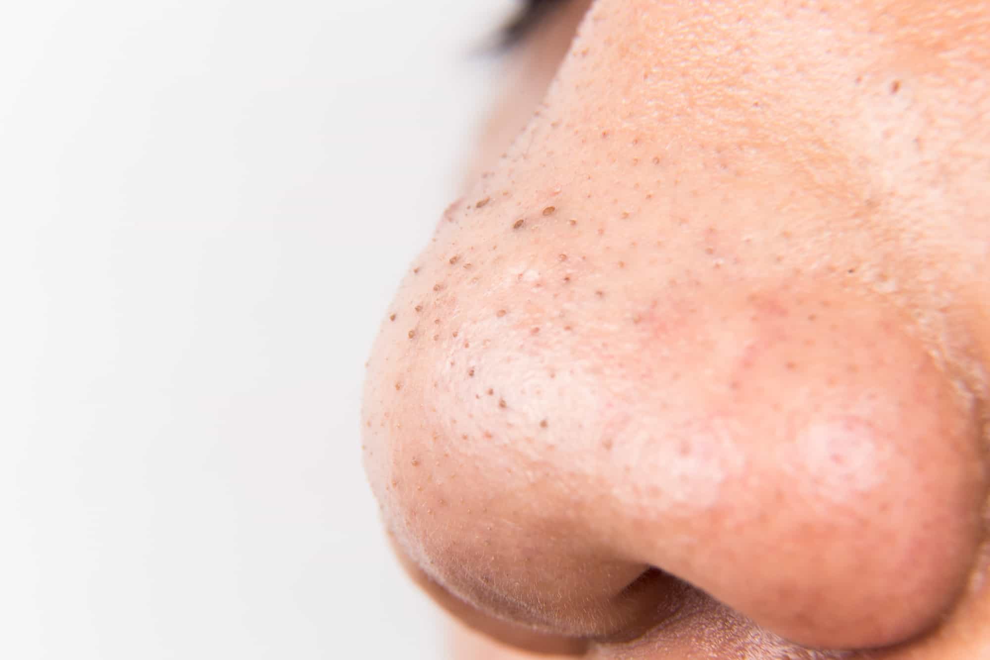 What causes blackheads and how to treat them