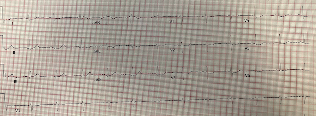 Should you record posterior leads?  Should you give thrombolytics for chest pain with this ECG (if PCI not available)?