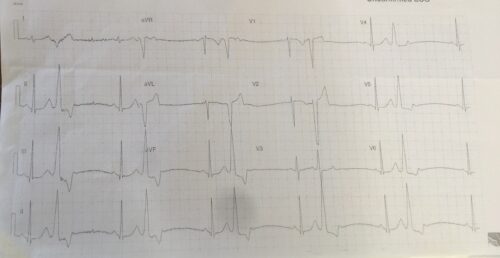 ECG of the Week 18th May 2022 Answer
