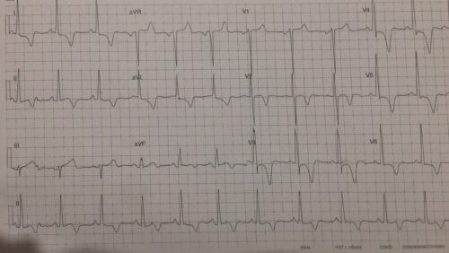 ECG of the Week 27th April 2022 Answer