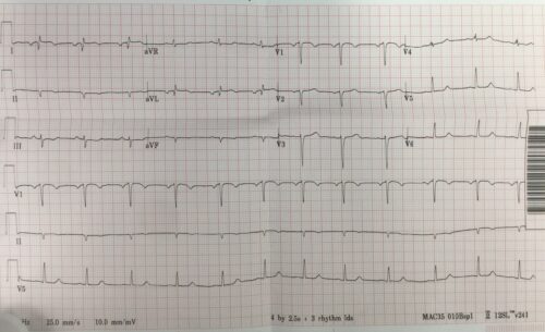 ECG of the Week 30th March 2022 Answer