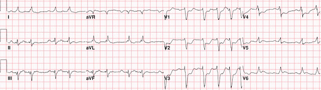 Right precordial ST depression in a patient with chest pain