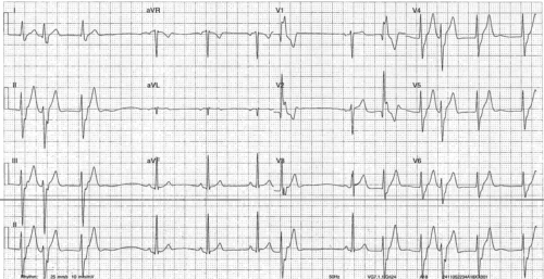 ECG of the week 13th Nov 24
