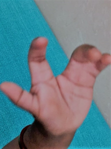 Ectrodactyly-a rare limb malformation | Pediatric Oncall Journal