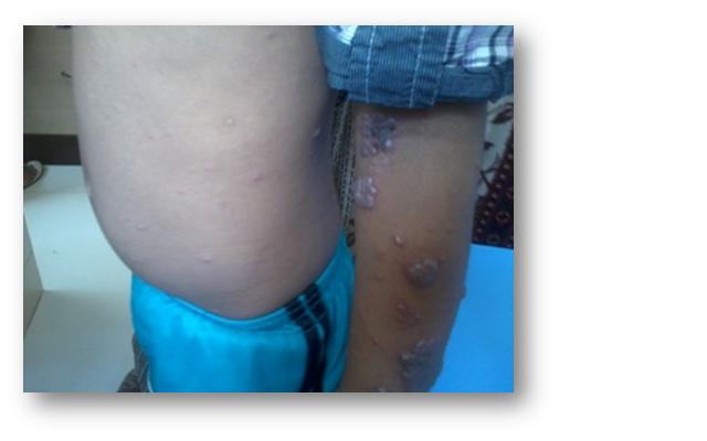 Dermatomal skin rash and generalized rash (concurrent appearance of herpes zoster and varicella)