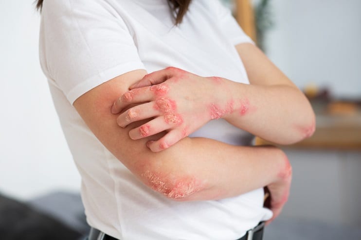 Hand, Foot & Mouth Disease: Symptoms & Causes