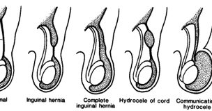 Paediatric Emergency Medicine: Paediatric Hernias