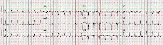 Prehospital Cath Lab Activation for inferior "STEMI" — do you agree?