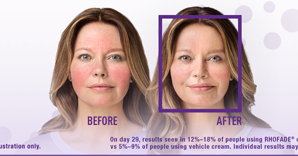 Allergan Should Be Red in the Face for Using “Before & After” Images in Rhofade & Kybella Ads