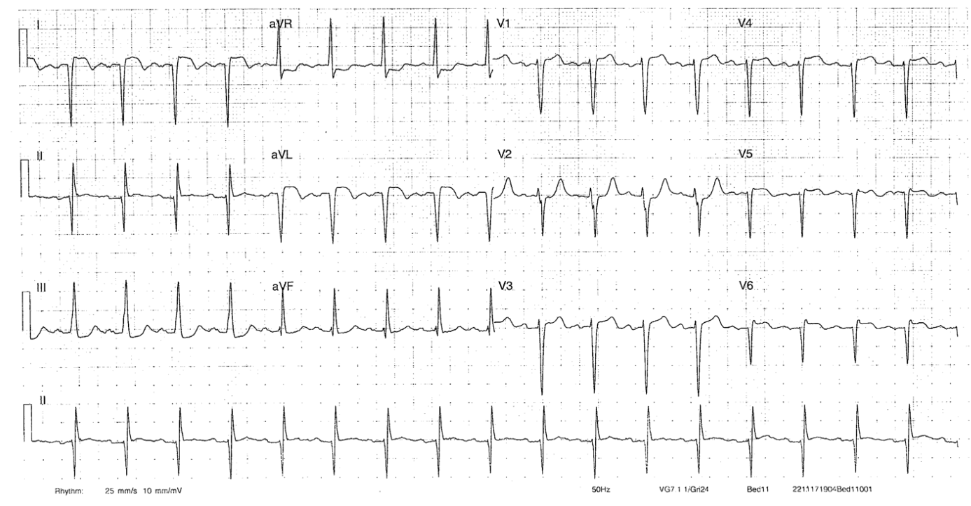 ECG of the Week 23rd November 2022 – Interpretation