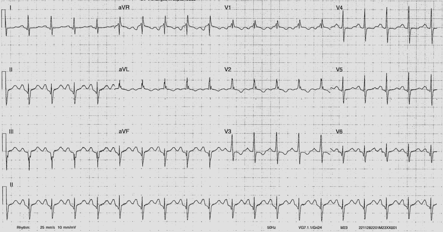 ECG of the Week 30th November 2022