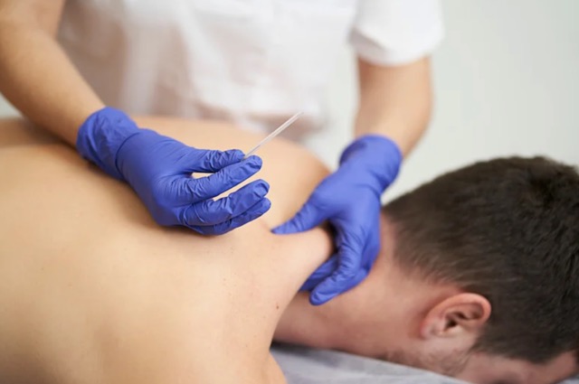 Relieving headaches with Dry Needling