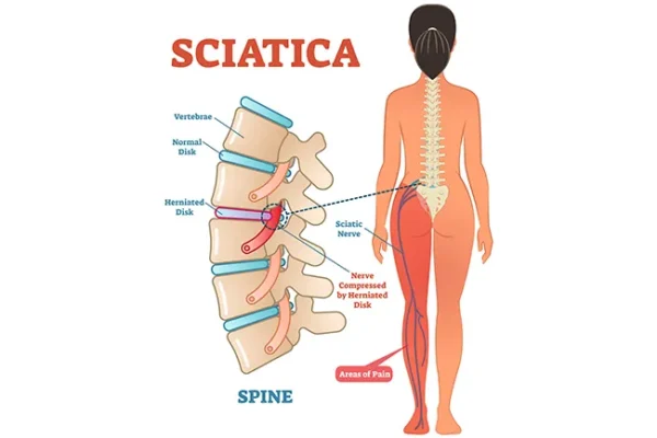 Addressing Sciatic Pain: Start Early for Best Results