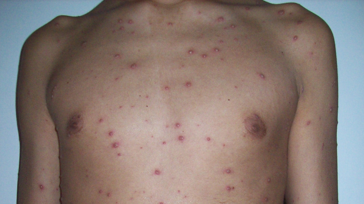 UK adds chickenpox to childhood vaccination schedule