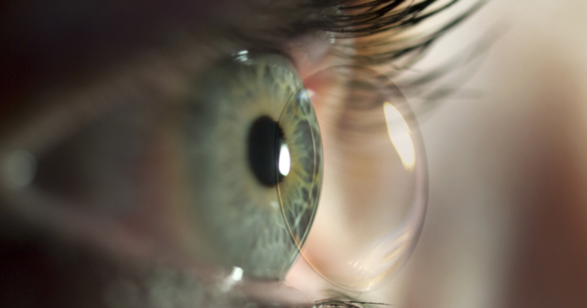 Better myopia control seen with ortho-K lenses, atropine