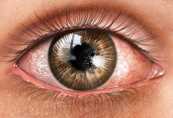 Dry eye disease, including causes, symptoms and treatment