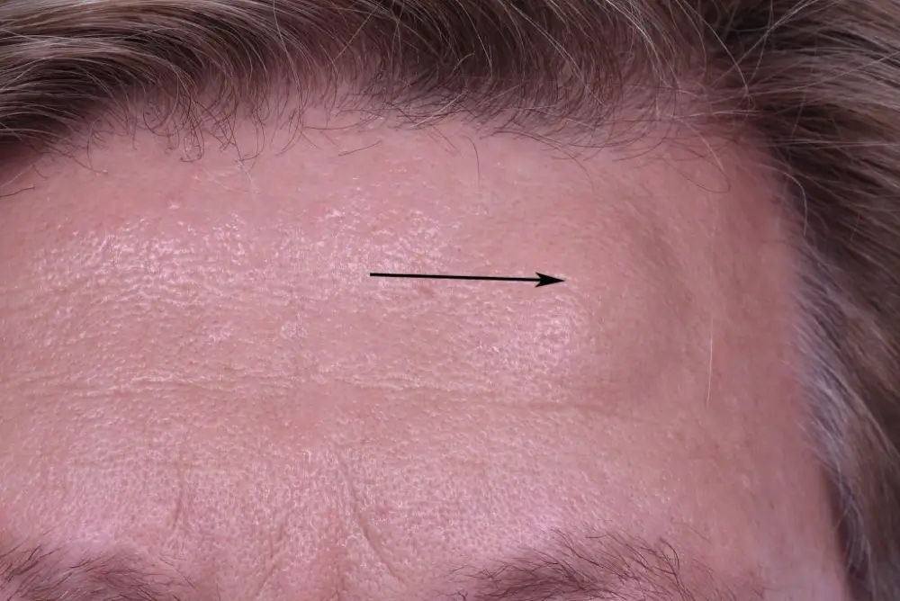 Forehead Osteoma Natural Treatment – 5 Effective Remedies