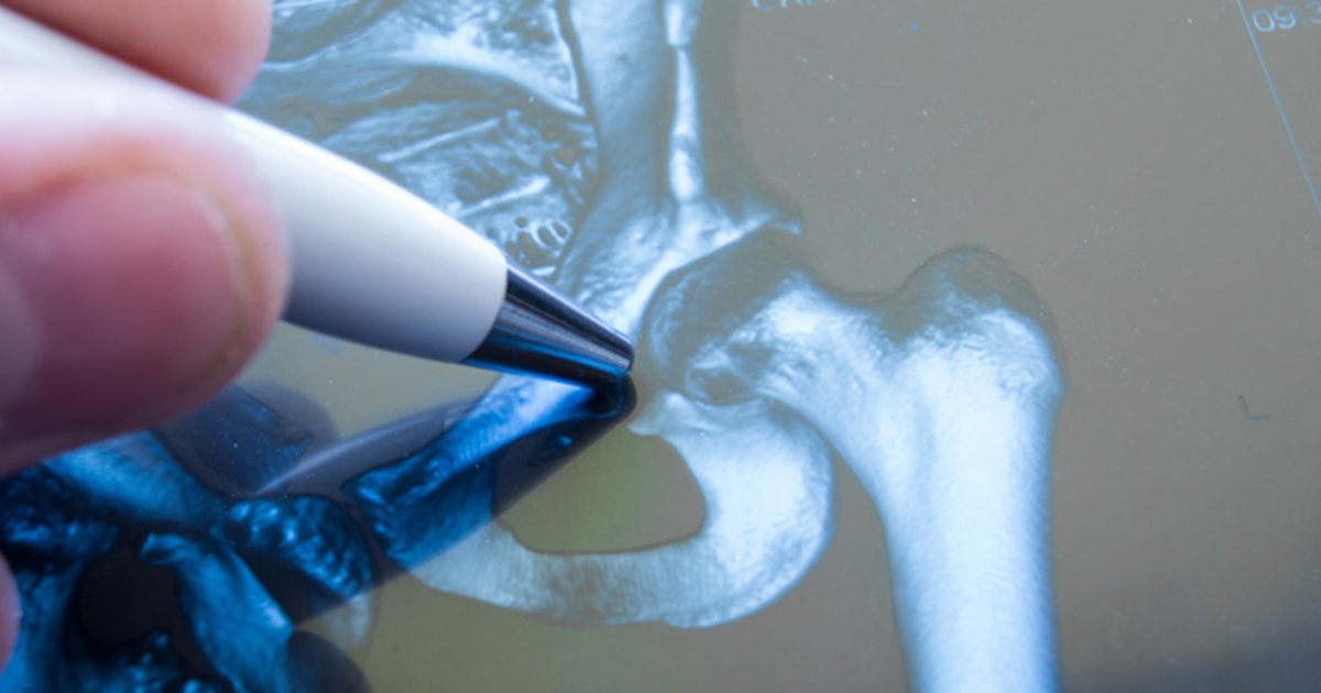 TRAVERSE fracture outcomes raise need for more research