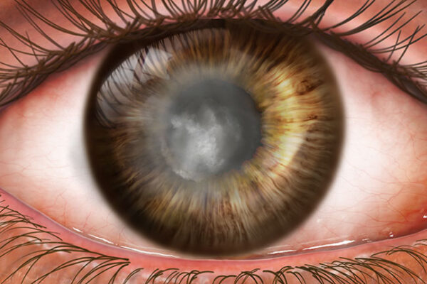 Fuchs’ dystrophy is a disease that affects the cornea. Treatment in Florida.
