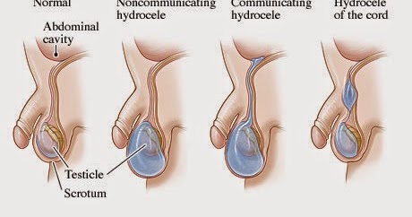 Paediatric Emergency Medicine: Non Torsion Scrotum