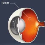 Long-term benefits seen with Gore-Tex sutures for scleral fixation of IOLs