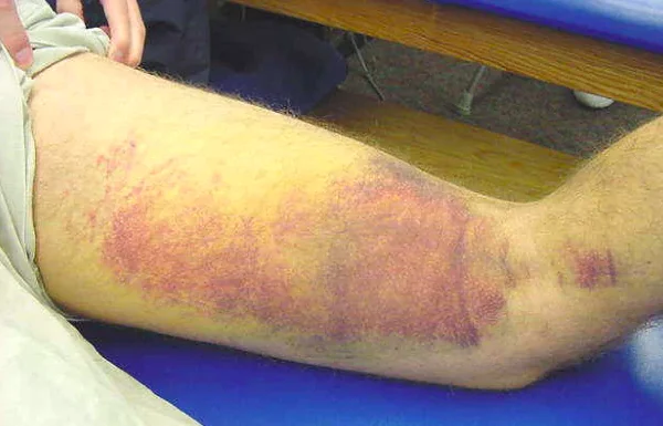 HAMSTRING INJURIES: TREATMENT WITH PHYSICAL THERAPY