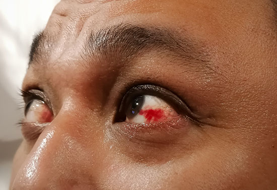 Subconjunctival hemorrhage, whites of the eye bleeding