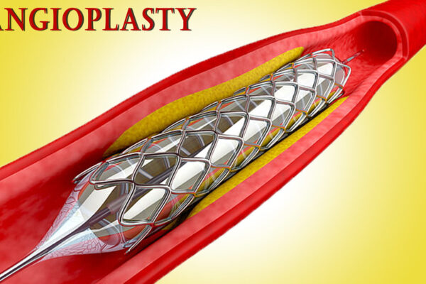 Stent Supply to Kerala Govt Hospitals Halted