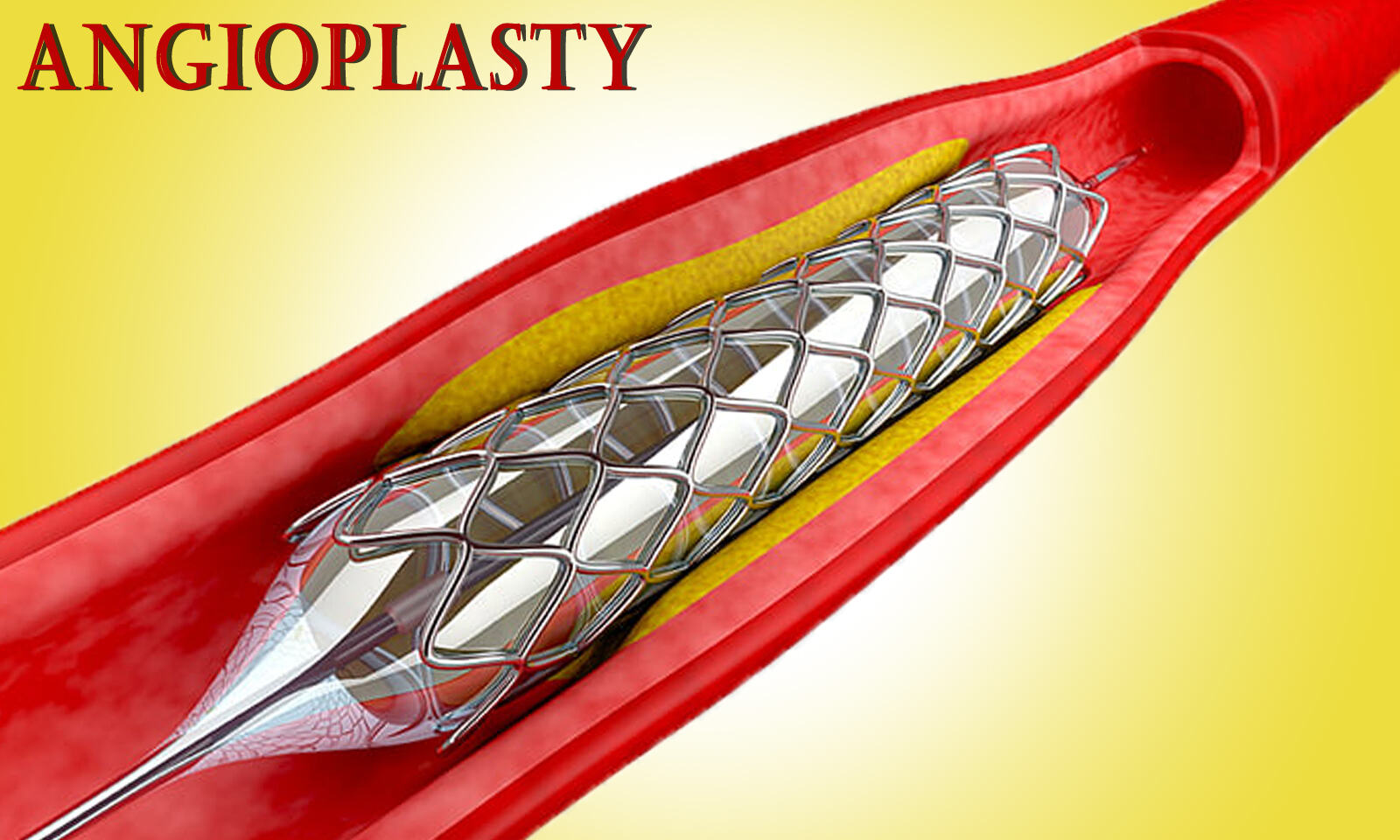 Stent Supply to Kerala Govt Hospitals Halted