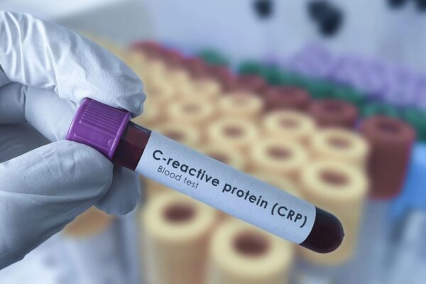 C-reactive Protein–Triglyceride Glucose Index Independently Predicts Stroke Risk in Cardiovascular-Kidney-Metabolic Syndrome: Study