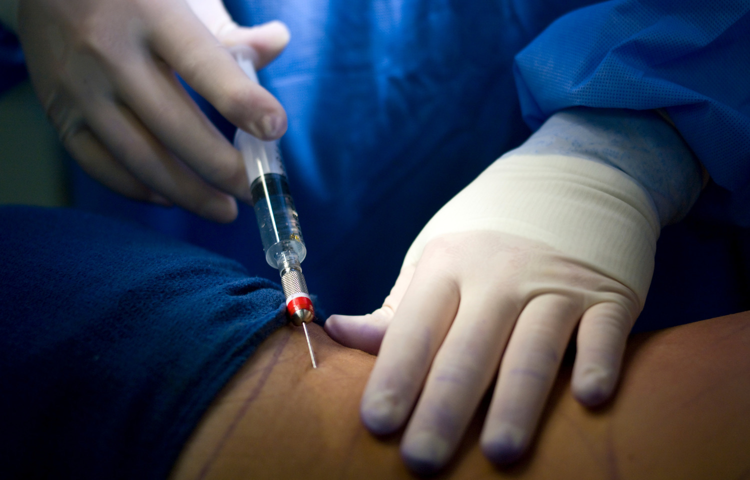 Perfusion Index may Predict for SAIH in Orthopedic Surgery, Less Effective in Elderly: Study