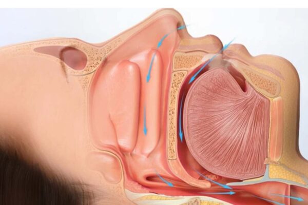 Undiagnosed Sleep-Disordered Breathing Worsens Heart Function in HCM Patients: JAMA