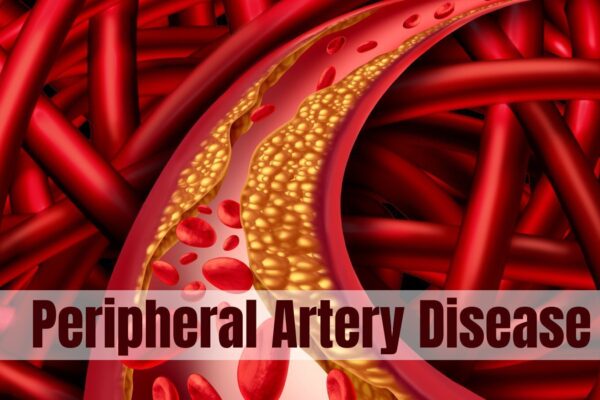 Drug-coated devices do not improve outcomes in patients with peripheral artery disease: ESC Study Drug-coated devices do not improve outcomes in patients with peripheral artery disease: ESC Study