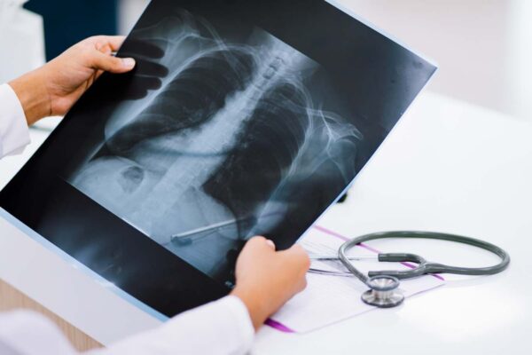 Achalasia diagnosis simplified to AI plus X-ray, suggests study