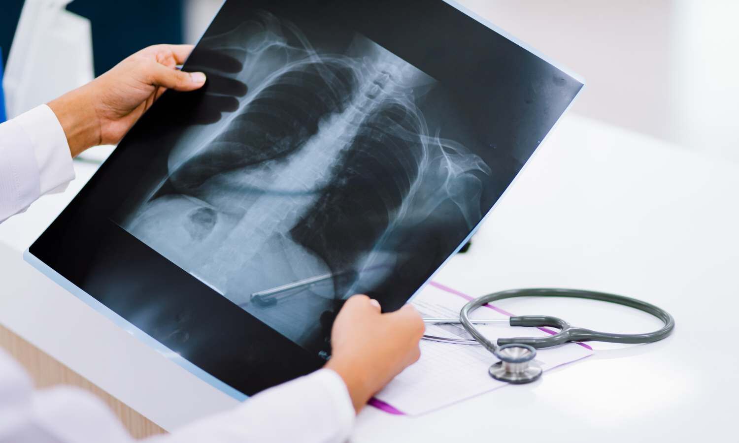 Achalasia diagnosis simplified to AI plus X-ray, suggests study
