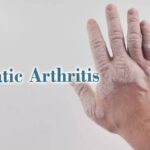 Early DMARD Initiation Improves Disease Control in Psoriatic Arthritis, Suggests Study