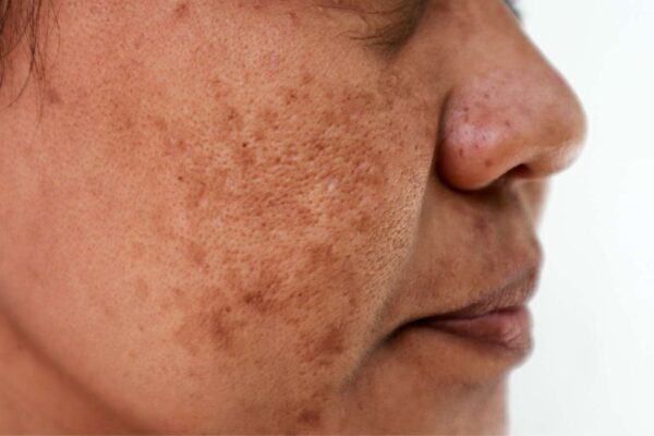 AOPT-LTL Therapy Improves Melasma via SCF/c-KIT Pathway Inhibition: Study Finds