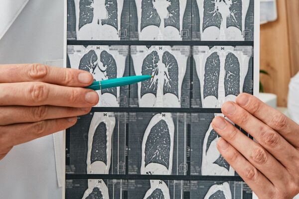 Emphysema at CT lung screening increases death risk in asymptomatic adults: Study
