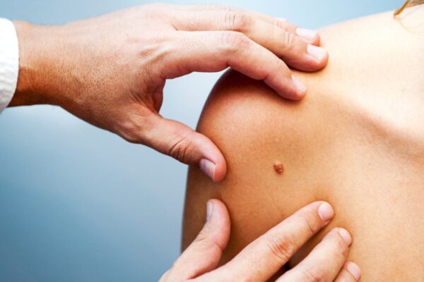 Melanoma Patients Face Greater Risk of Vitiligo, Psoriasis, and Other Autoimmune Conditions: Study Finds