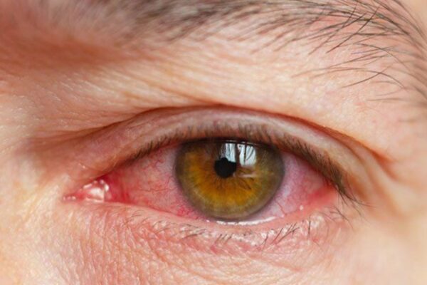 Meta-Analysis Reveals Higher Risk of Dry Eye in Patients with Inflammatory Bowel Disease