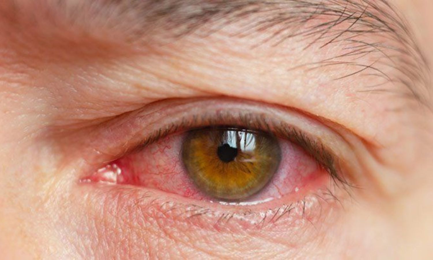 Meta-Analysis Reveals Higher Risk of Dry Eye in Patients with Inflammatory Bowel Disease