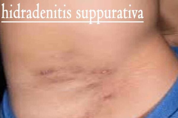 Global Study Finds Nearly 1 Percent of Population Affected by Hidradenitis Suppurativa