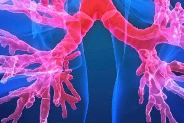 Symptoms Predict Exacerbation Risk in Bronchiectasis, Suggesting Expanded Role for Macrolide Therapy: Study Finds