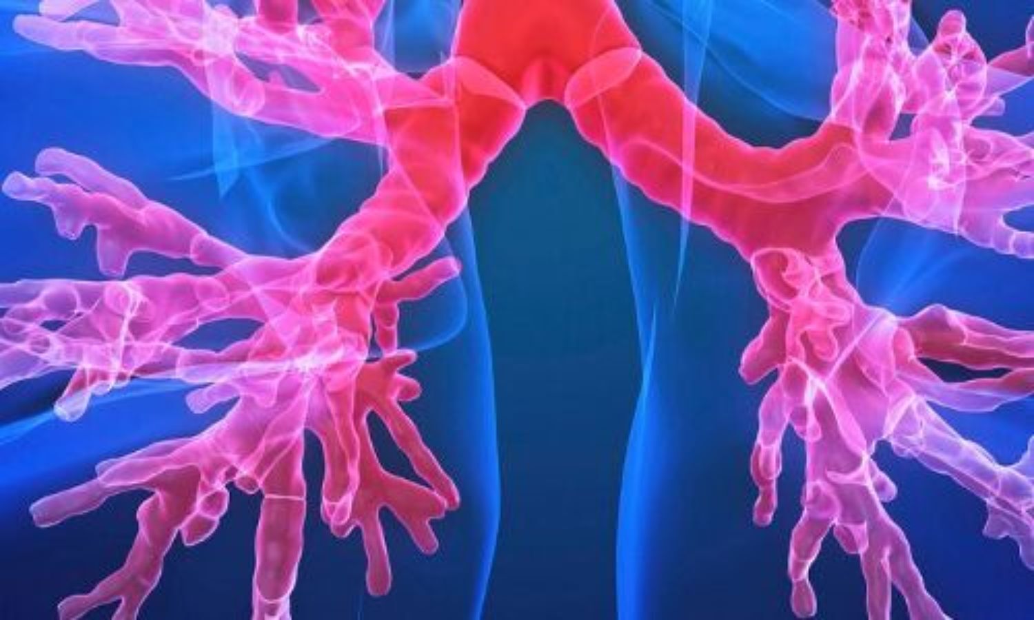 Symptoms Predict Exacerbation Risk in Bronchiectasis, Suggesting Expanded Role for Macrolide Therapy: Study Finds