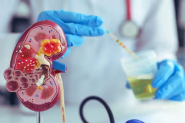 Half of Lupus Patients Develop Chronic Kidney Disease, Even Without Nephritis: Study Suggests