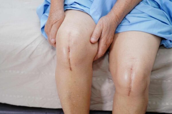 Exercise After Knee Replacement Cuts Heart and Stroke Risks, Study Suggests