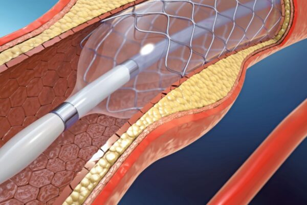 Hemodialysis Patients Face Higher Restenosis Risk After DCB Therapy, But Limb Salvage Remains High: POPCORN Registry